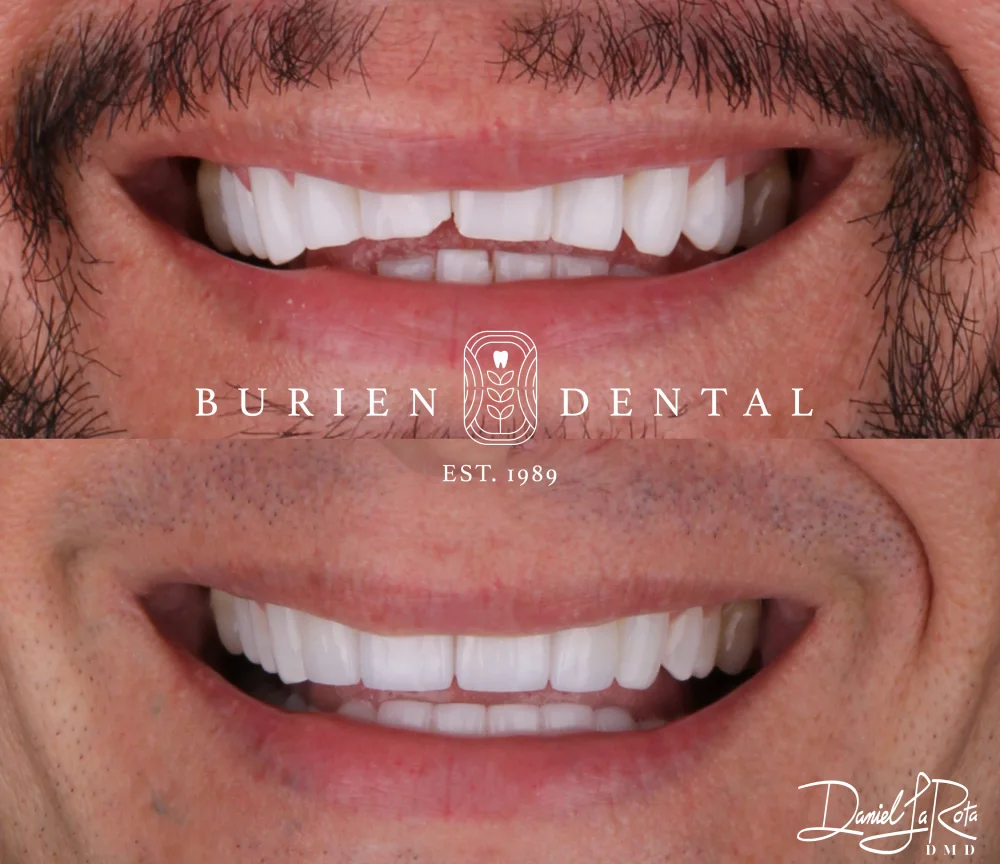 Before and after dental treatment showing stained upper teeth corrected to a brighter, even smile at Burien Dental.