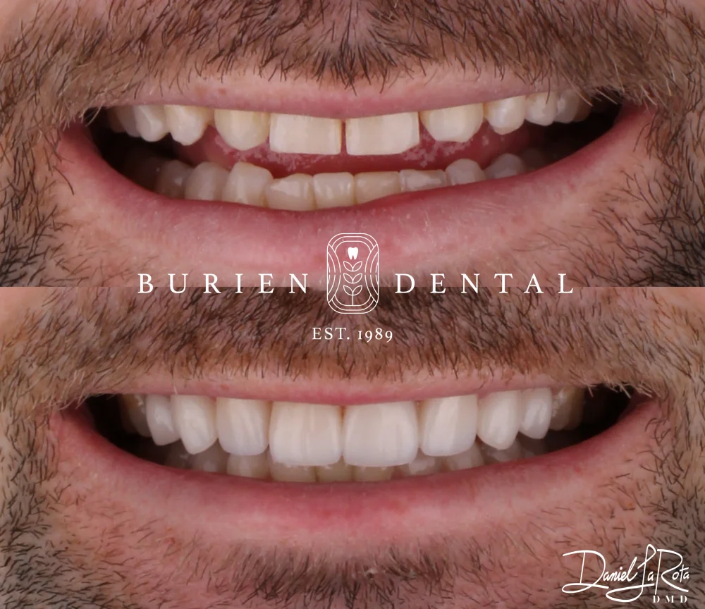 Smile makeover progression showing chipped and darkened teeth restored to a bright, healthy appearance.