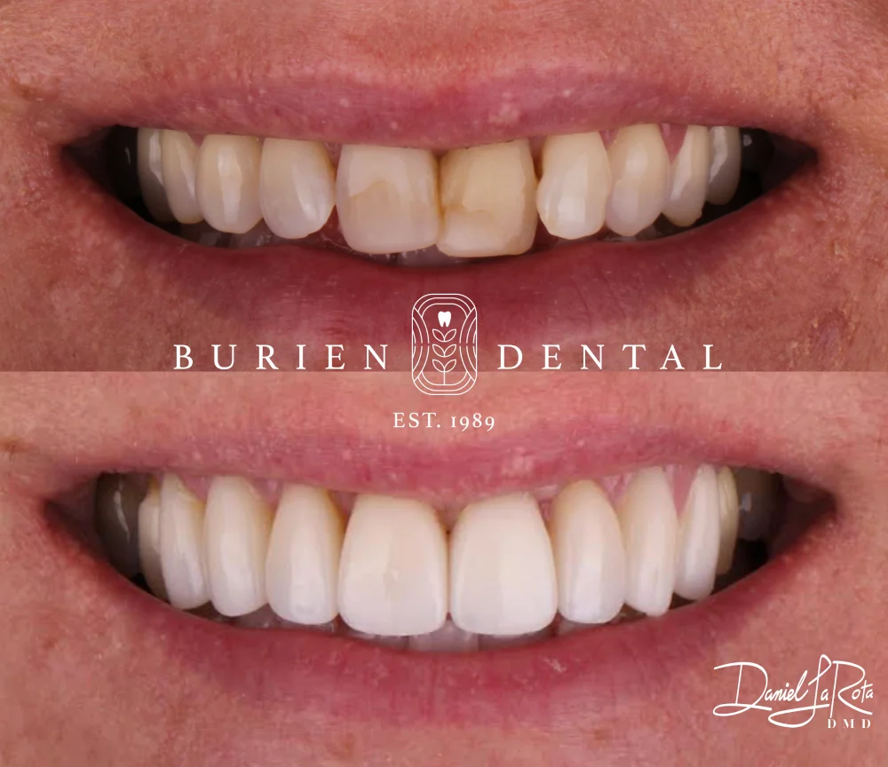 Before and after photos illustrating whitening and restorative enhancements performed by Burien Dental.
