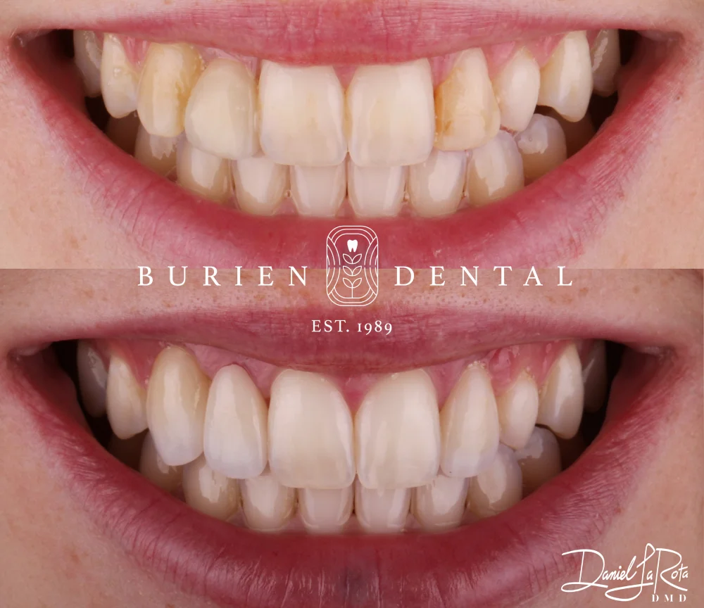 Close-up comparison of a patient’s smile before and after whitening and cosmetic restoration by Burien Dental.