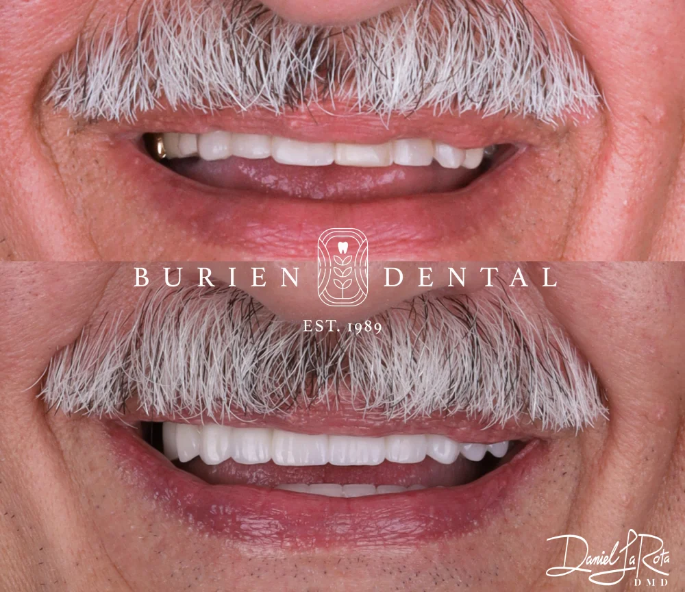 Before photo with yellowed, uneven teeth next to an after photo featuring smooth, natural-looking veneers.