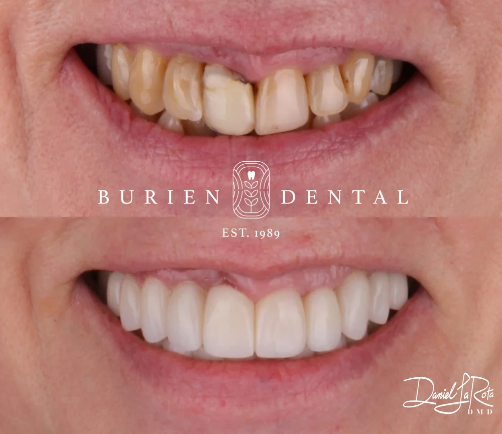 Transformation of a patient’s smile from worn, discolored teeth to a smooth, bright, and aligned&nbsp;finish.