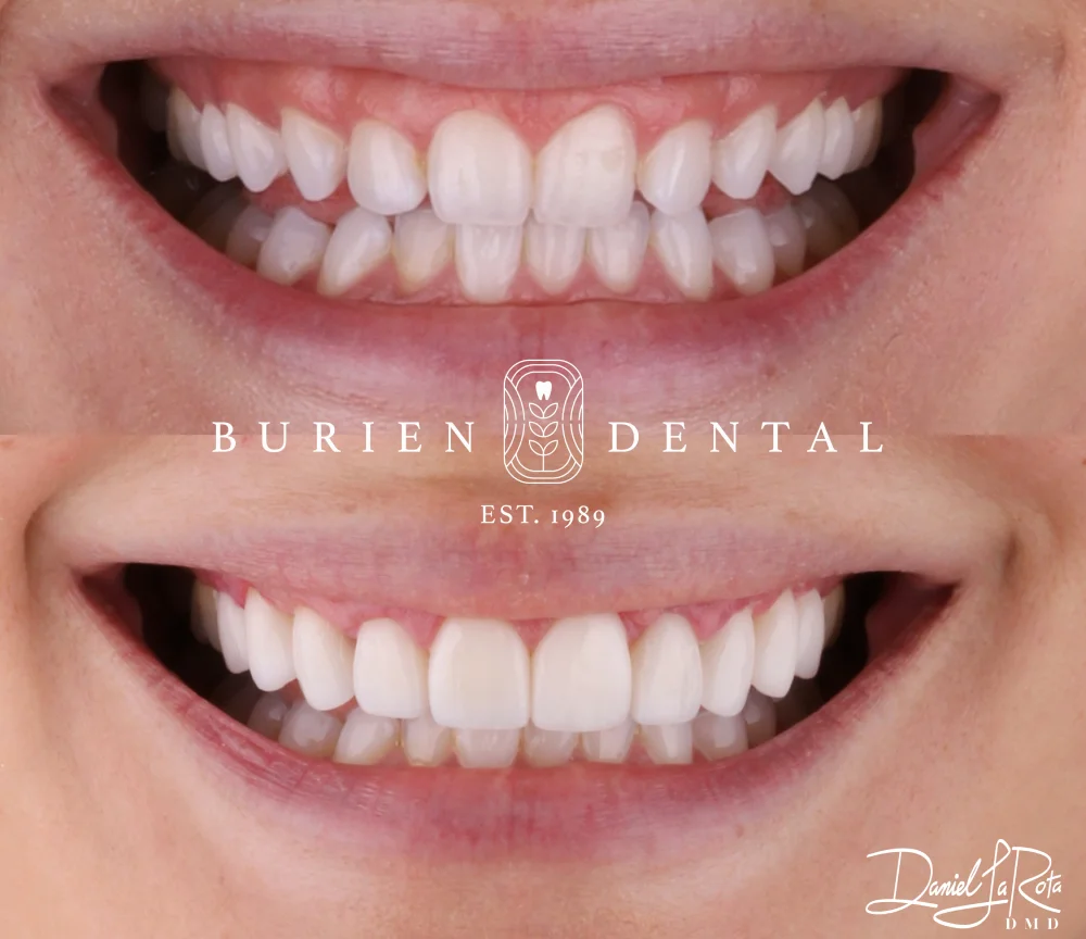 Side-by-side smile transformation highlighting improved tooth color, shape, and alignment after dental care.